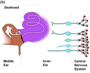 Damaged situation of the middle and inner ear; hair cells are damaged or non-existent, nerve cells are not fully developed or do not reach the cochlea [3].
